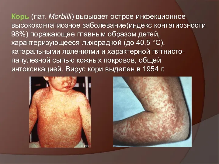 Корь (лат. Morbilli) вызывает острое инфекционное высококонтагиозное заболевание(индекс контагиозности 98%)