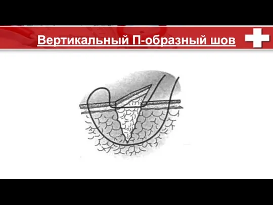 Вертикальный П-образный шов