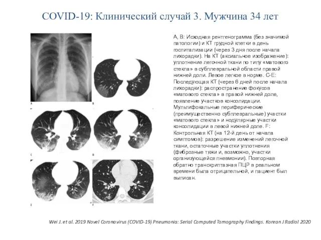 COVID-19: Клинический случай 3. Мужчина 34 лет А, В: Исходная рентгенограмма (без значимой