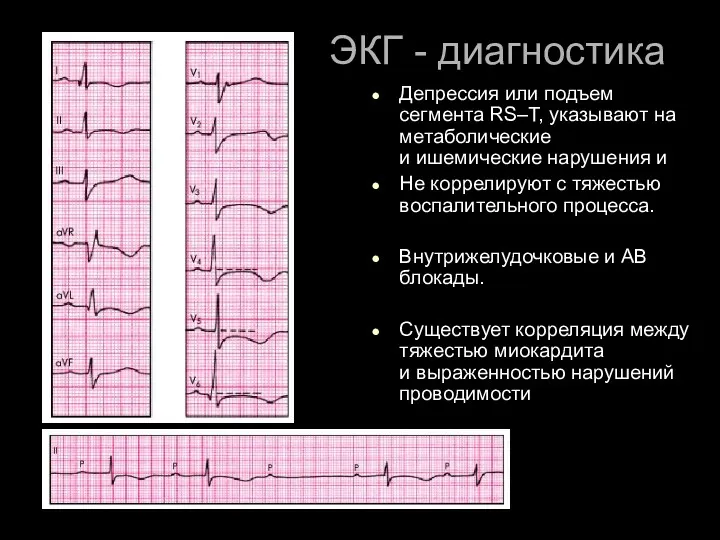 ЭКГ - диагностика Депрессия или подъем сегмента RS–Т, указывают на