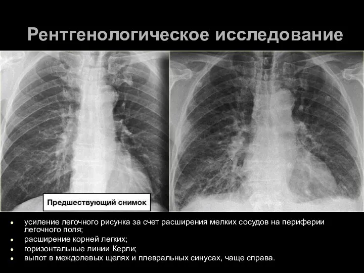 Рентгенологическое исследование усиление легочного рисунка за счет расширения мелких сосудов