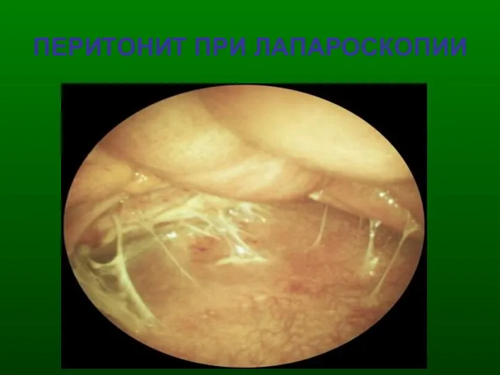 ПЕРИТОНИТ ПРИ ЛАПАРОСКОПИИ