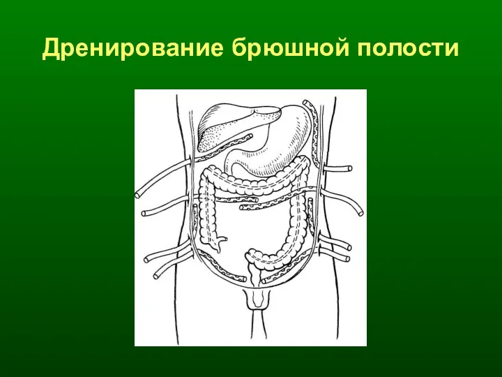 Дренирование брюшной полости