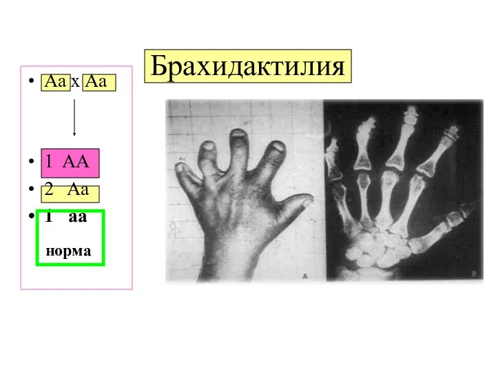 Брахидактилия Aa x Aa 1 AA 2 Aa 1 aa норма