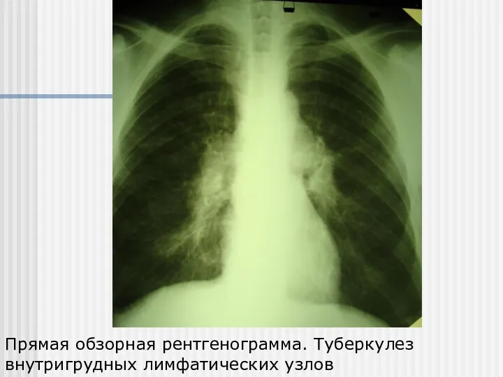 Прямая обзорная рентгенограмма. Туберкулез внутригрудных лимфатических узлов