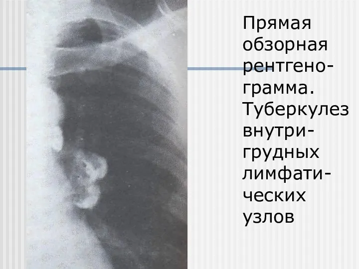 Прямая обзорная рентгено-грамма. Туберкулез внутри-грудных лимфати-ческих узлов