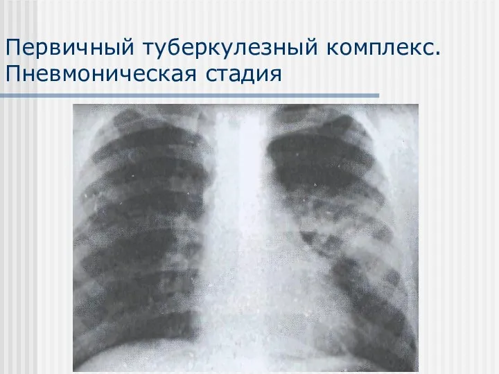 Первичный туберкулезный комплекс. Пневмоническая стадия