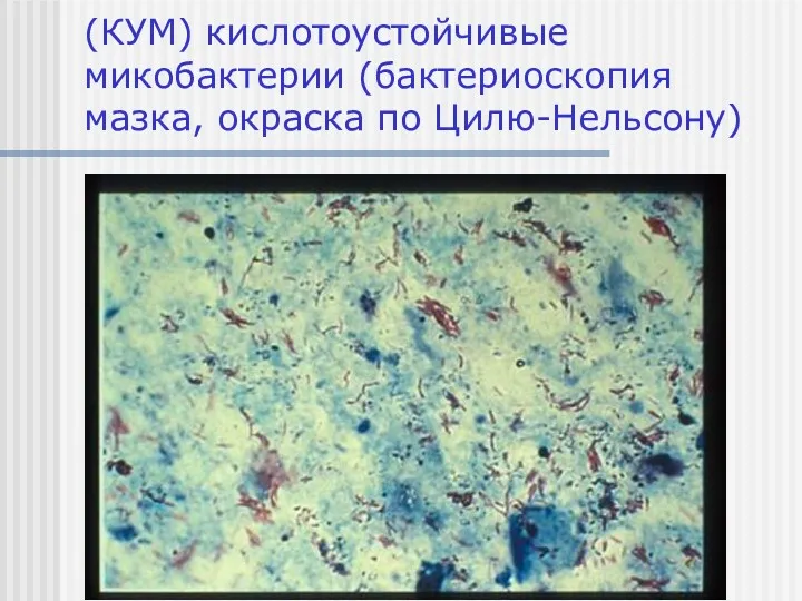 (КУМ) кислотоустойчивые микобактерии (бактериоскопия мазка, окраска по Цилю-Нельсону)