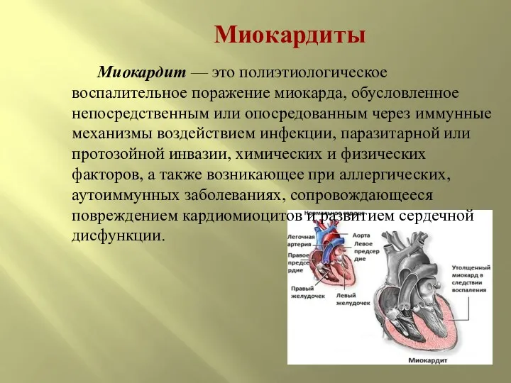 Миокардиты Миокардит — это полиэтиологическое воспалительное поражение миокарда, обусловленное непосредственным