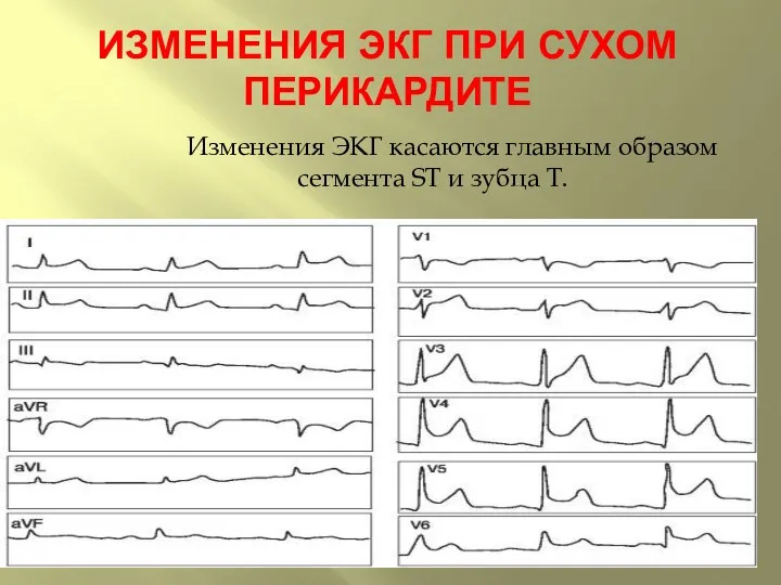 ИЗМЕНЕНИЯ ЭКГ ПРИ СУХОМ ПЕРИКАРДИТЕ Изменения ЭКГ касаются главным образом сегмента ST и зубца Т.