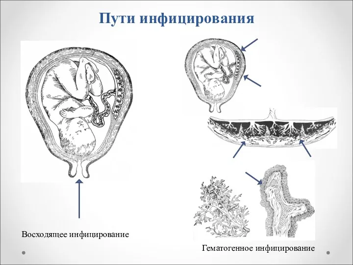 Пути инфицирования Восходящее инфицирование Гематогенное инфицирование