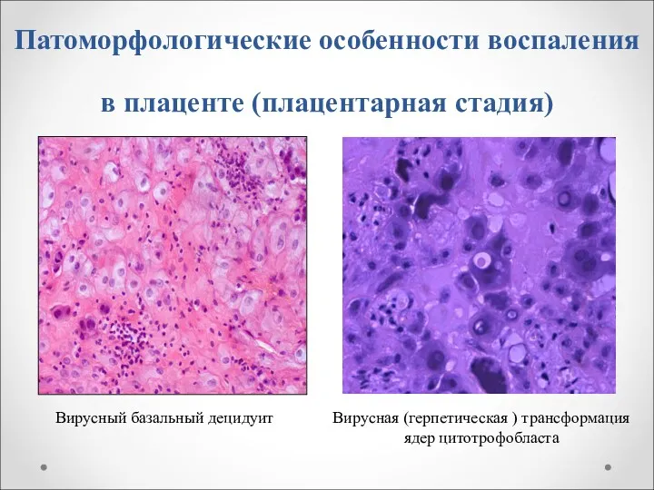 Патоморфологические особенности воспаления в плаценте (плацентарная стадия) Вирусный базальный децидуит Вирусная (герпетическая ) трансформация ядер цитотрофобласта