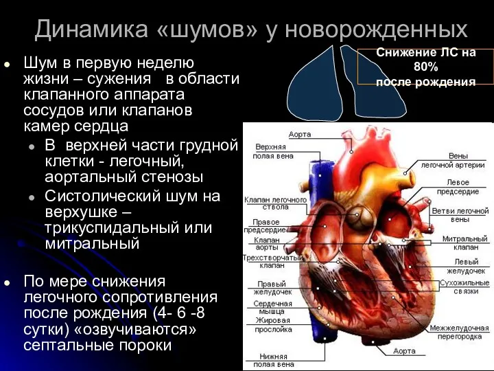 Динамика «шумов» у новорожденных Шум в первую неделю жизни – сужения в области