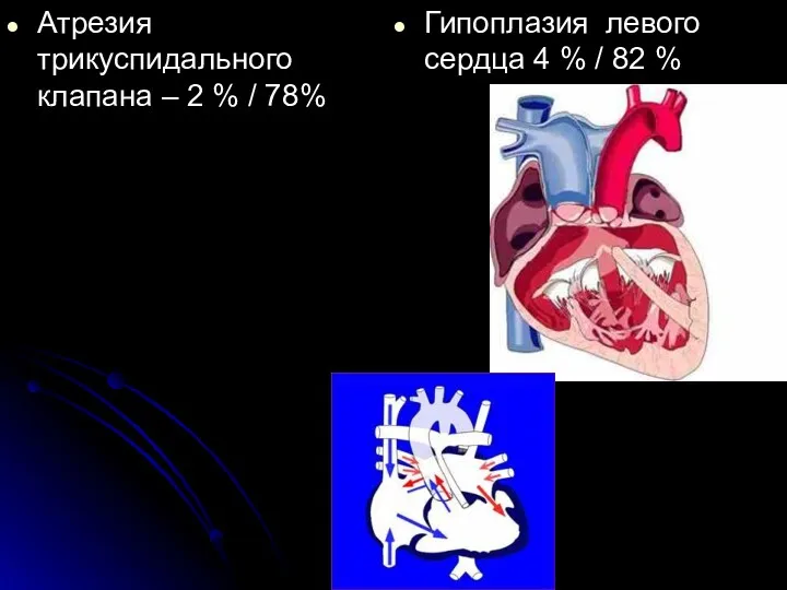 Атрезия трикуспидального клапана – 2 % / 78% Гипоплазия левого сердца 4 % / 82 %