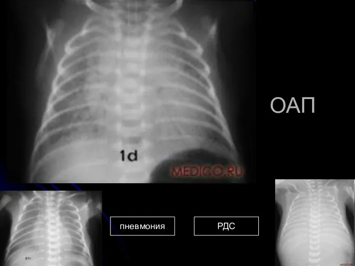 ОАП пневмония РДС