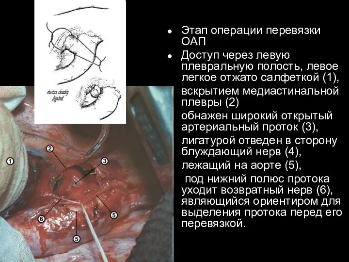 Этап операции перевязки ОАП Доступ через левую плевральную полость, левое легкое отжато салфеткой