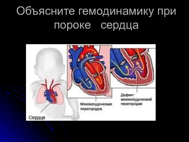 Объясните гемодинамику при пороке сердца