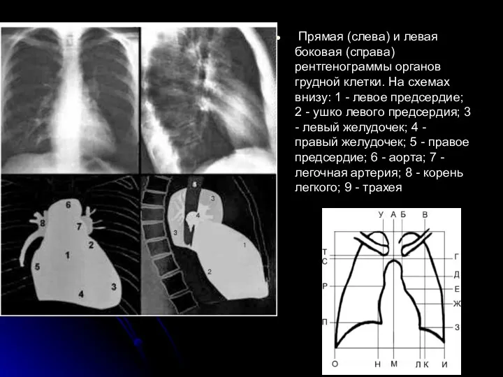 Прямая (слева) и левая боковая (справа) рентгенограммы органов грудной клетки. На схемах внизу: