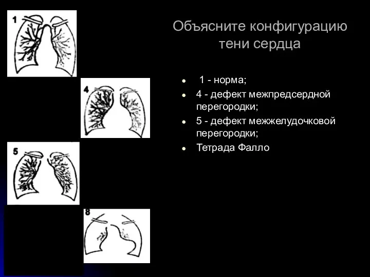 Объясните конфигурацию тени сердца 1 - норма; 4 - дефект межпредсердной перегородки; 5