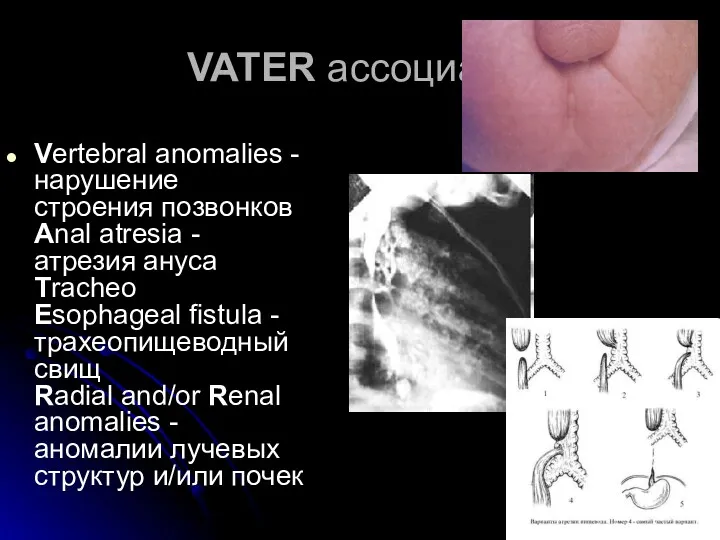 VATER ассоциация Vertebral anomalies - нарушение строения позвонков Anal atresia - атрезия ануса