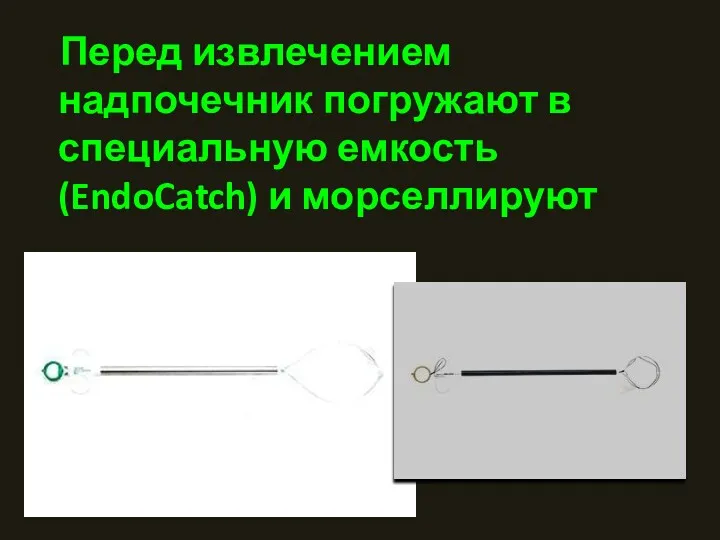 Перед извлечением надпочечник погружают в специальную емкость (EndoCatch) и морселлируют