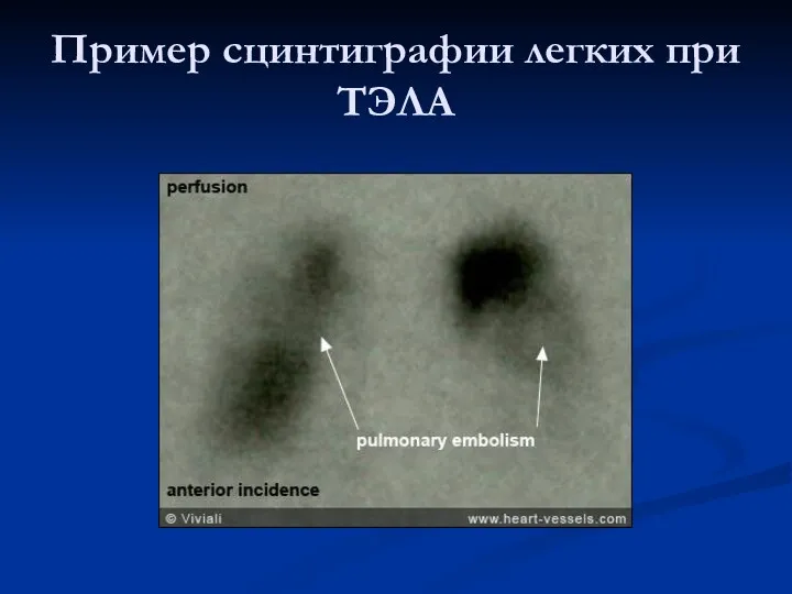 Пример сцинтиграфии легких при ТЭЛА