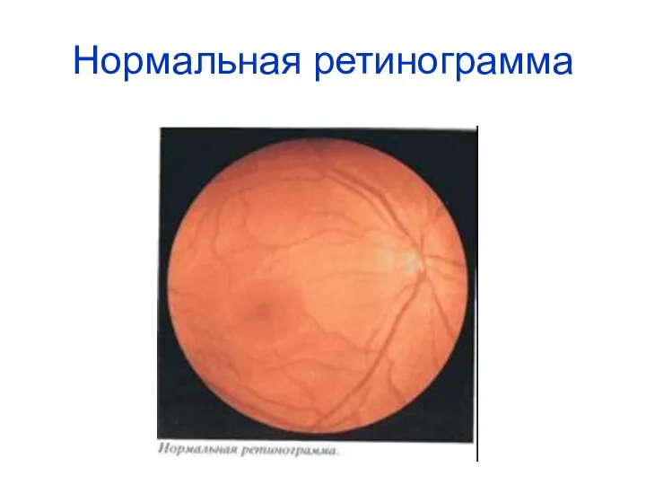 Нормальная ретинограмма