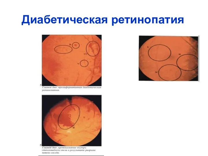 Диабетическая ретинопатия