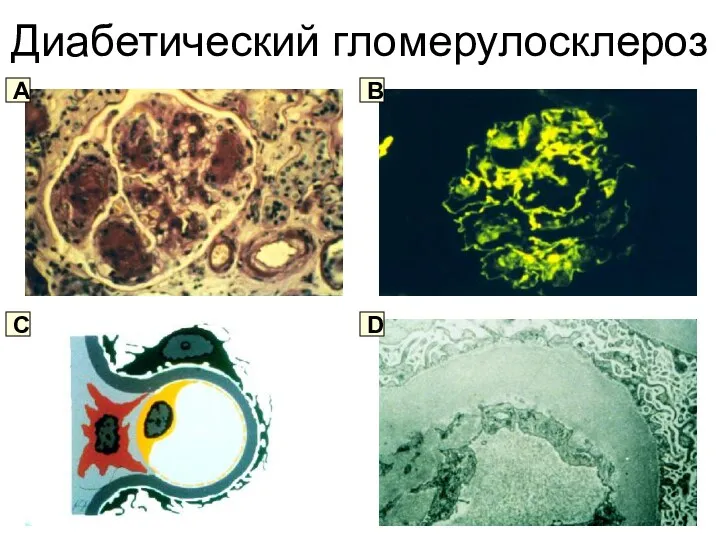 Диабетический гломерулосклероз