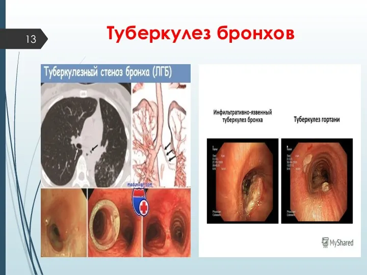 Туберкулез бронхов