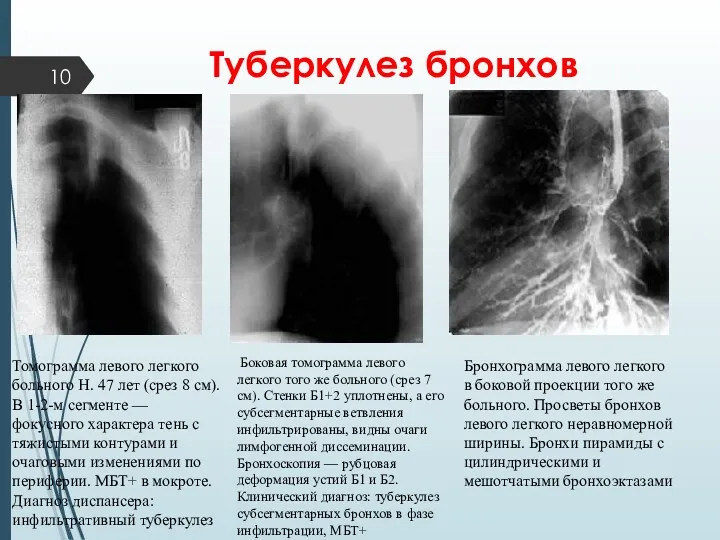 Туберкулез бронхов Бронхограмма левого легкого в боковой проекции того же