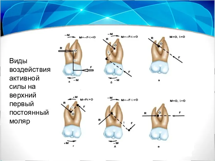 Виды воздействия активной силы на верхний первый постоянный моляр