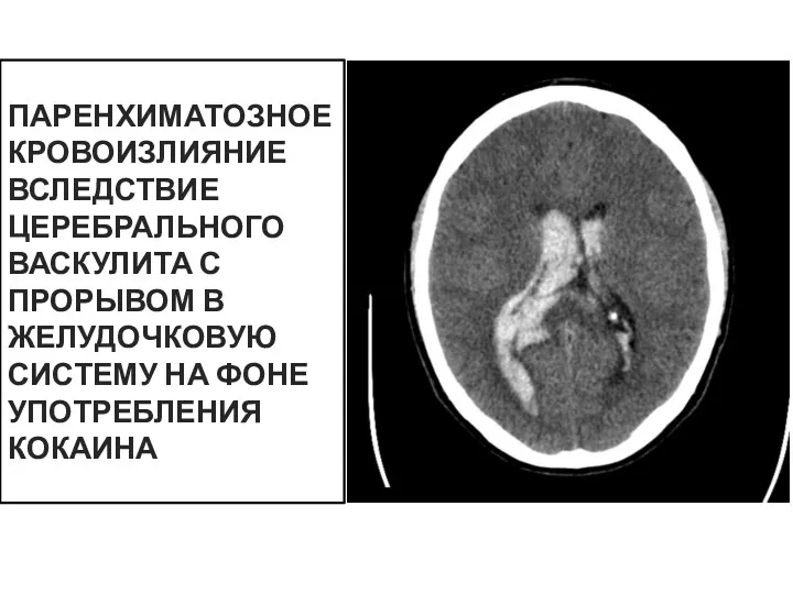 ПАРЕНХИМАТОЗНОЕ КРОВОИЗЛИЯНИЕ ВСЛЕДСТВИЕ ЦЕРЕБРАЛЬНОГО ВАСКУЛИТА С ПРОРЫВОМ В ЖЕЛУДОЧКОВУЮ СИСТЕМУ НА ФОНЕ УПОТРЕБЛЕНИЯ КОКАИНА