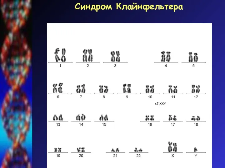 Синдром Клайнфельтера