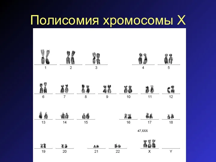 Полисомия хромосомы Х