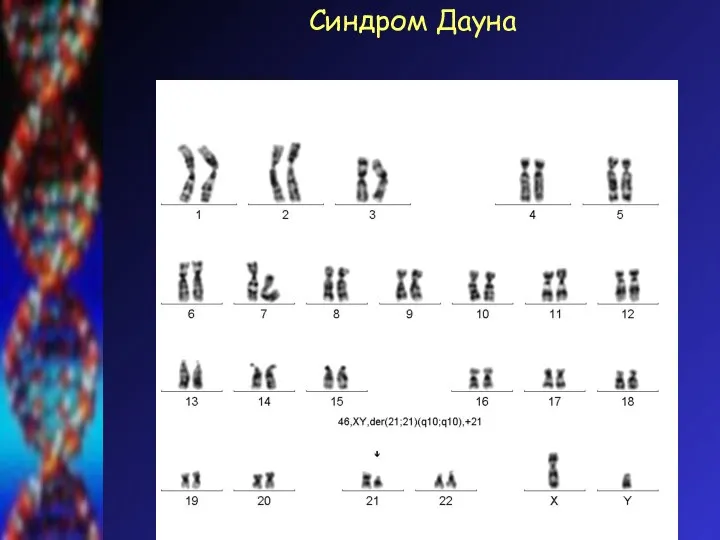 Синдром Дауна