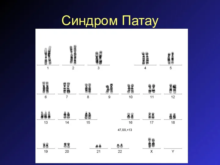 Синдром Патау