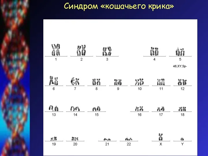 Синдром «кошачьего крика»