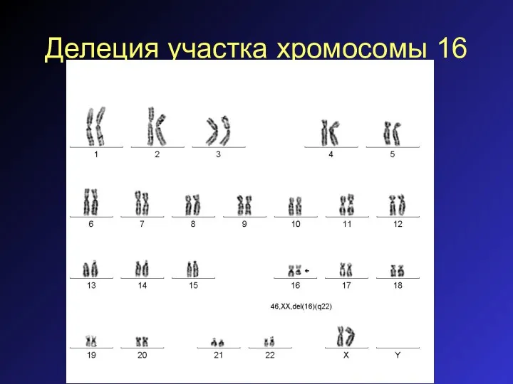 Делеция участка хромосомы 16
