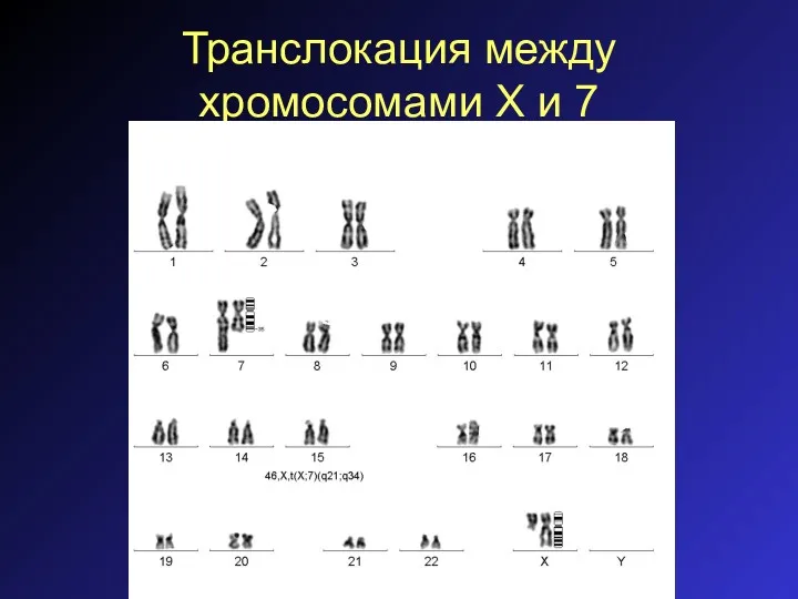 Транслокация между хромосомами Х и 7