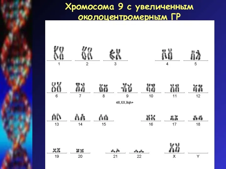 Хромосома 9 с увеличенным околоцентромерным ГР