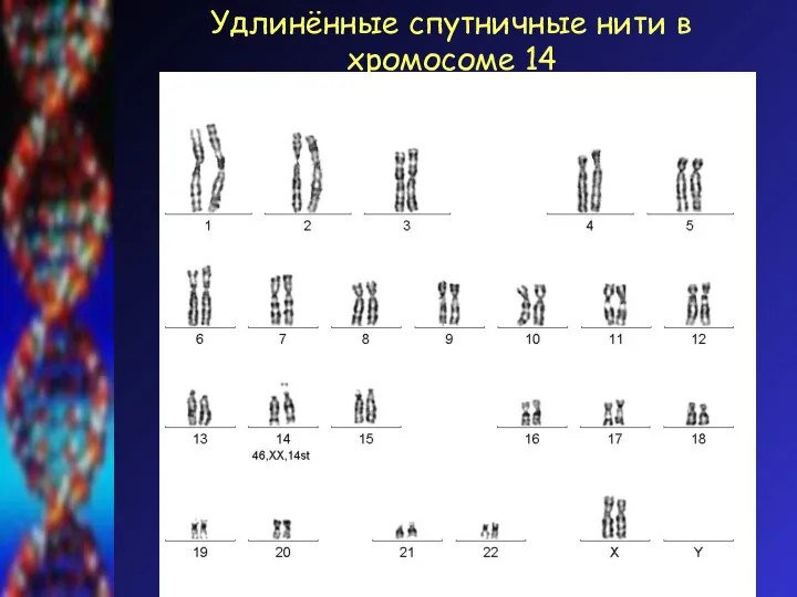 Удлинённые спутничные нити в хромосоме 14