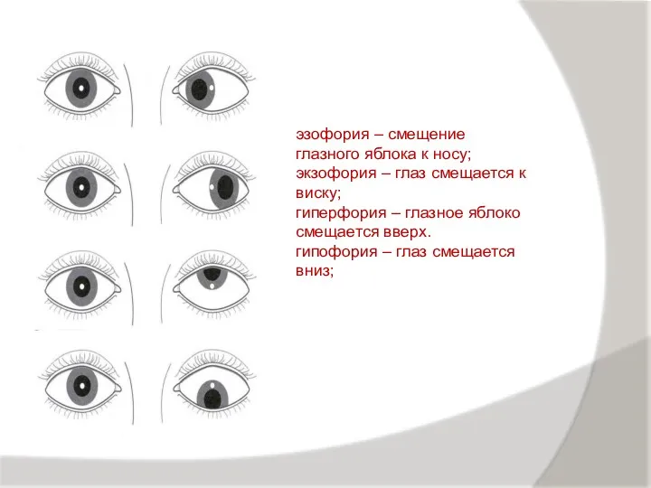 эзофория – смещение глазного яблока к носу; экзофория – глаз