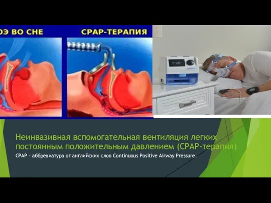 Неинвазивная вспомогательная вентиляция легких постоянным положительным давлением (СРАР-терапия) СРАР –