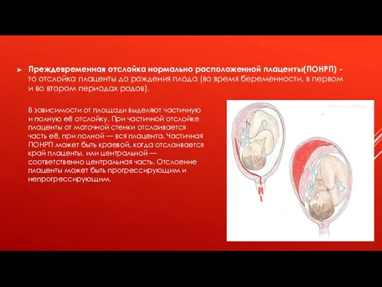 Преждевременная отслойка нормально расположенной плаценты(ПОНРП) - то отслойка плаценты до рождения плода (во
