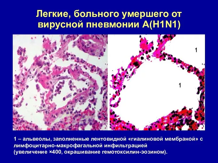 Легкие, больного умершего от вирусной пневмонии А(H1N1) 1 – альвеолы,