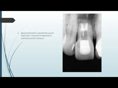 Двухкорневой двухканальный вариант строения верхнего центрального резца.