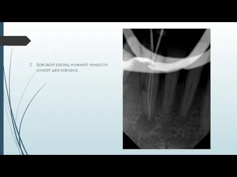 Боковой резец нижней челюсти имеет два канала.