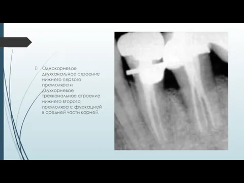 Однокорневое двухканальное строение нижнего первого премоляра и двухкорневое трехканальное строение