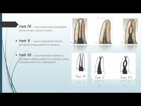 тип IV— два отдельных корневых канала при одном устье. тип